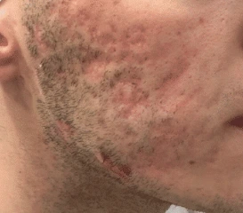 לפני הטיפול, עור הפנים עם צלקות אקנה