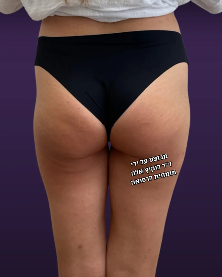 לפני הטיפול, הישבן, מבט מאחור