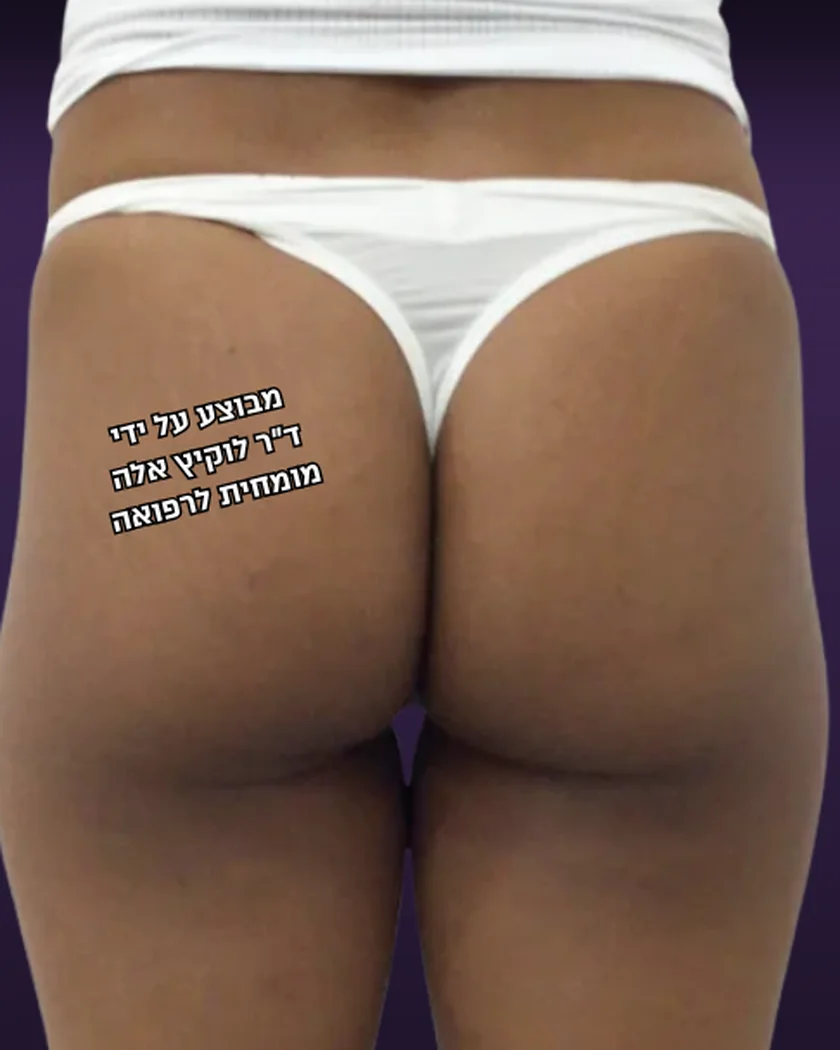 לפני הטיפול, הישבן, מבט מאחור