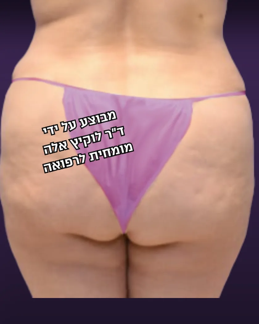 לפני הטיפול, הישבן, מבט מאחור