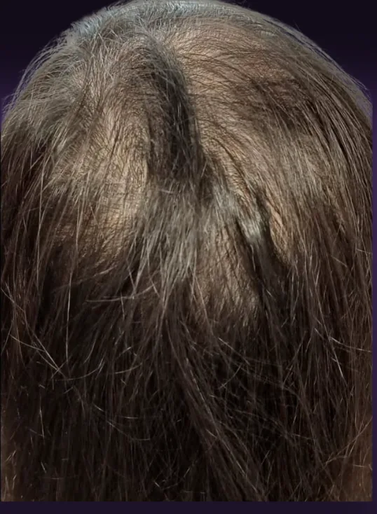 אחרי הטיפול, קודקוד של מטופל מלמעלה