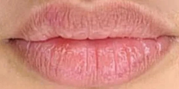 לפני הטיפול, שפתיים, תקריב