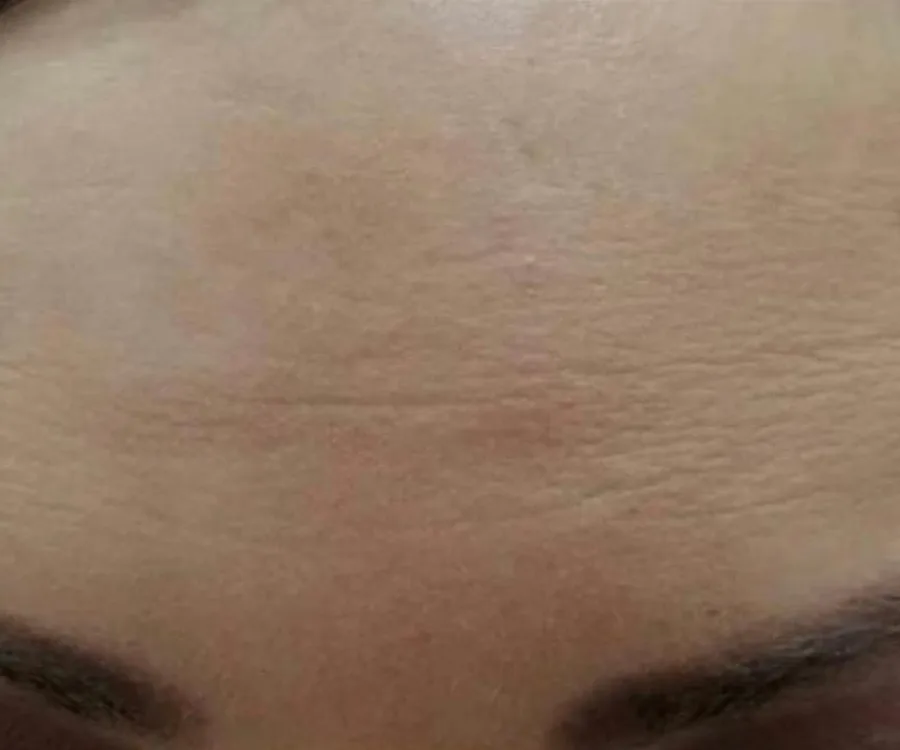אחרי טיפול בבוטוקס