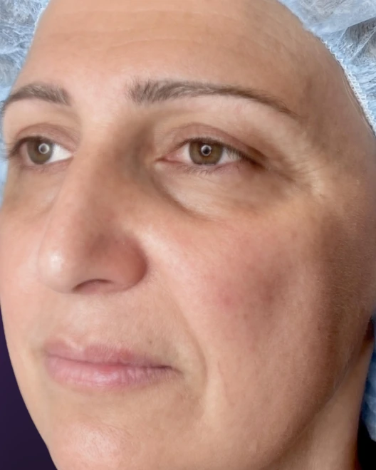 לפני הטיפול, עור הפנים, מבט חצי צד